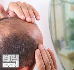 الإعلان عن انتاج دواء جديد لاستعادة الشعر بالكامل