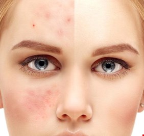 خبر سار.. علاج جديد لحب الشباب دون آثار جانبية