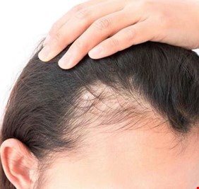 6 بدائل طبيعية لمحاربة تساقط الشعر