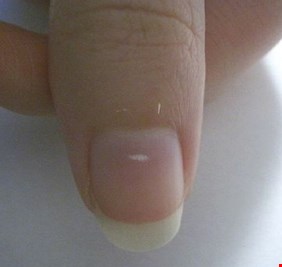 بقع الأظافر البيضاء تخفي علامات خطر لا علاقة لها بنقص الكالسيوم