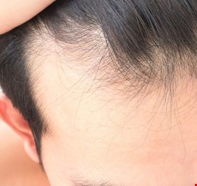 أول بنك للشعر في العالم لمكافحة الصلع