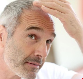 علاج للصلع.. هل هو حقيقي هذه المرَّة؟