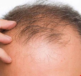 علماء يحققون إنجازا هاما نحو علاج الصلع نهائيا