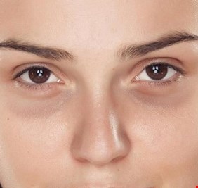 الهالات السوداء.. عادات سيئة تطفئ إشراقتك