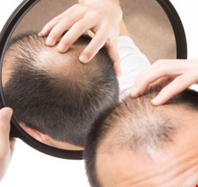 علاج الصلع.. حل سحري من الطبيعة