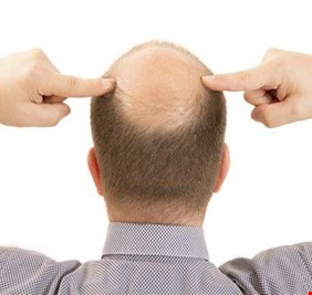 هل نقول وداعا للصلع؟ باحثون صينيون يصممون لصقة 