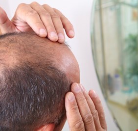 الإعلان عن انتاج دواء جديد لاستعادة الشعر بالكامل