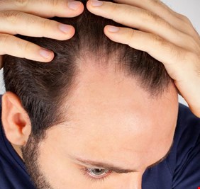 أطعمة تساعد على مكافحة الصلع