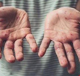 فيروس جدري القردة... وباء جديد يهدّد العالم