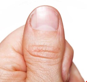 علامات تحذيرية على الأظافر قد تنذرك بارتفاع الكوليسترول