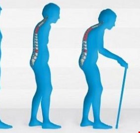 انحناء الظهر ليس سمة للشيخوخة!.. عندما تتحول عاداتنا اليومية إلى آلام مزمنة