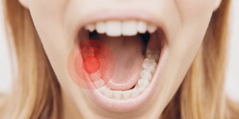 اكتشاف تأثير غير متوقع لقلع أضراس العقل