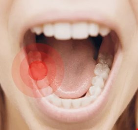 اكتشاف تأثير غير متوقع لقلع أضراس العقل